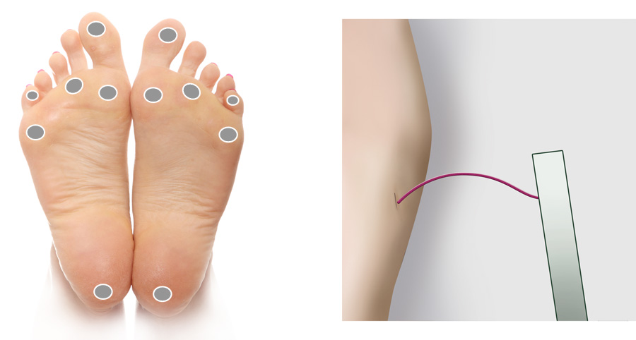 Illustration showing foot sensation assessment and a monofilament bending against the skin